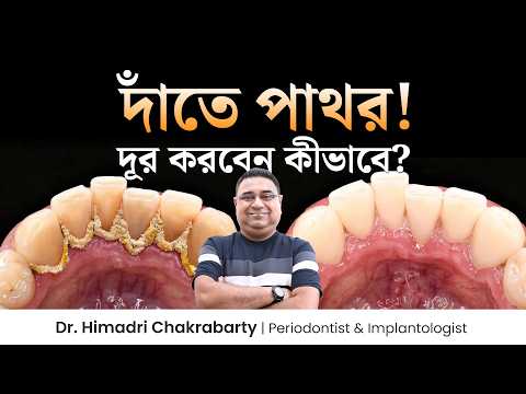 দাঁতে পাথর বা টারটার! দূর করবেন কীভাবে? Dr. Himadri Chakrabarty | Health Inside